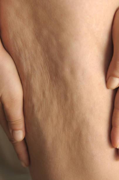 Gros plan sur une peau présentant un aspect peau d’orange lié à la cellulite