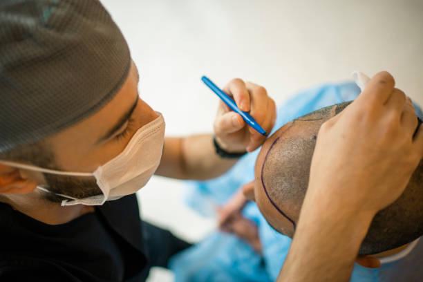 Greffe cheveux médecine esthétique