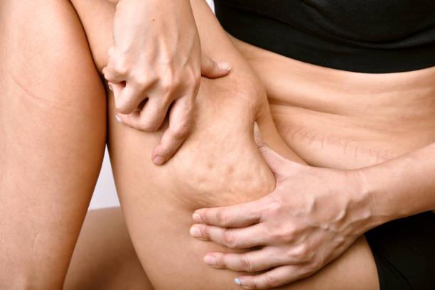 Traitement contre la cellulite 
