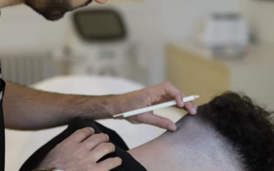 Combien de greffons pour une greffe capillaire selon la zone (golfes, ligne frontale, tonsure) ?