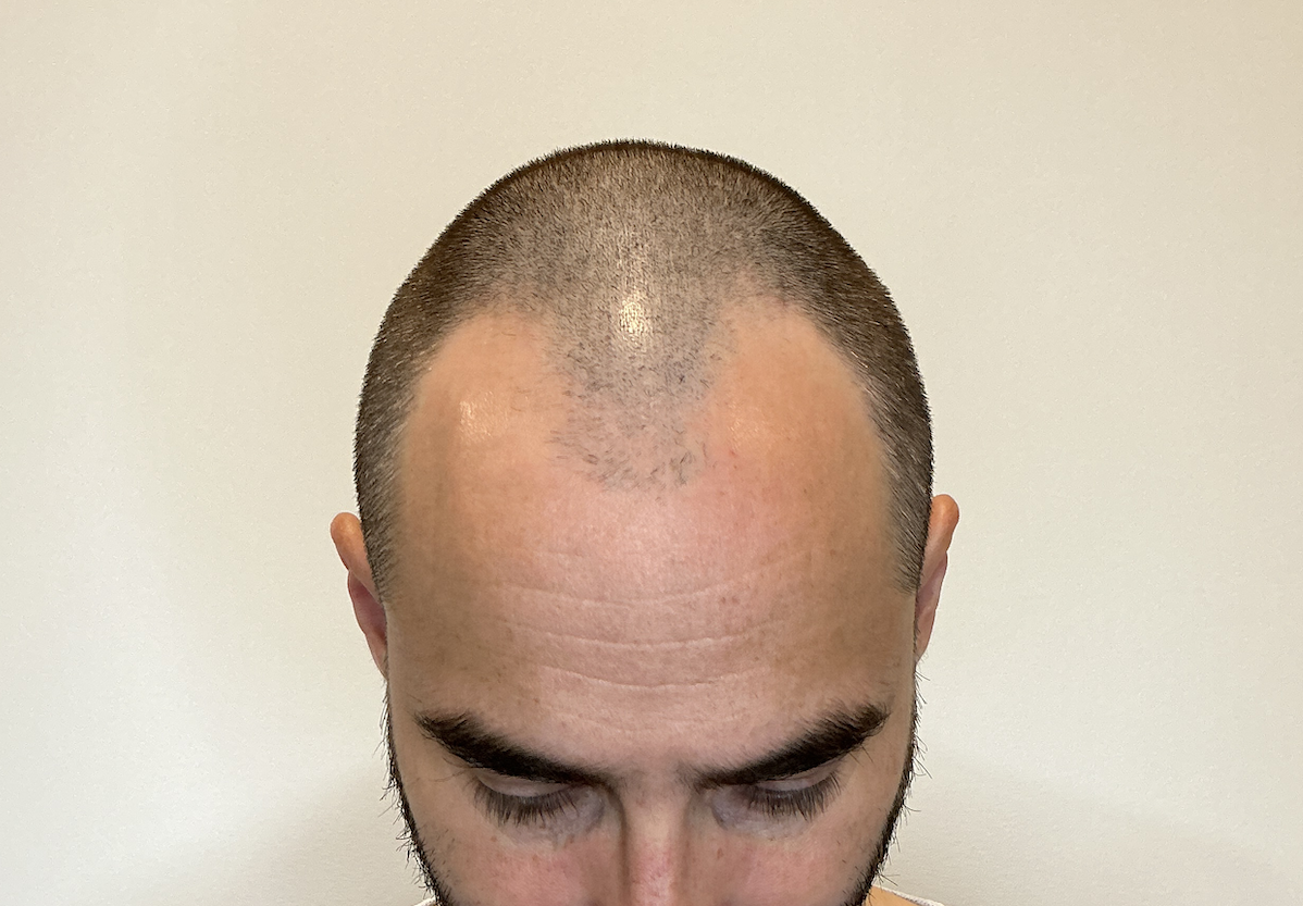 golfes creusés avant greffe capillaire à Bordeaux