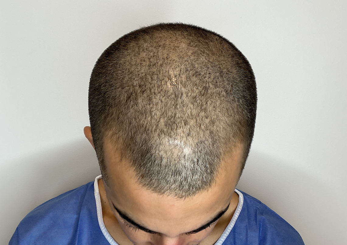 golfes légers avant greffe capillaire à Bordeaux