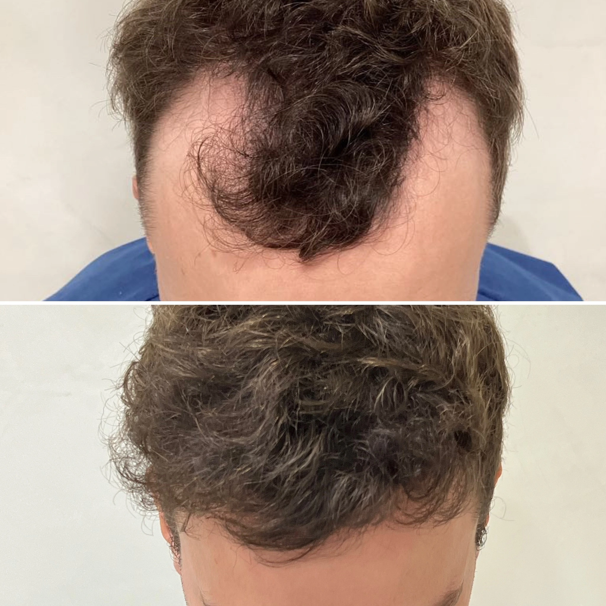 avant après greffe capillaire golfes avant après greffe capillaire golfes résultat naturel bordeaux