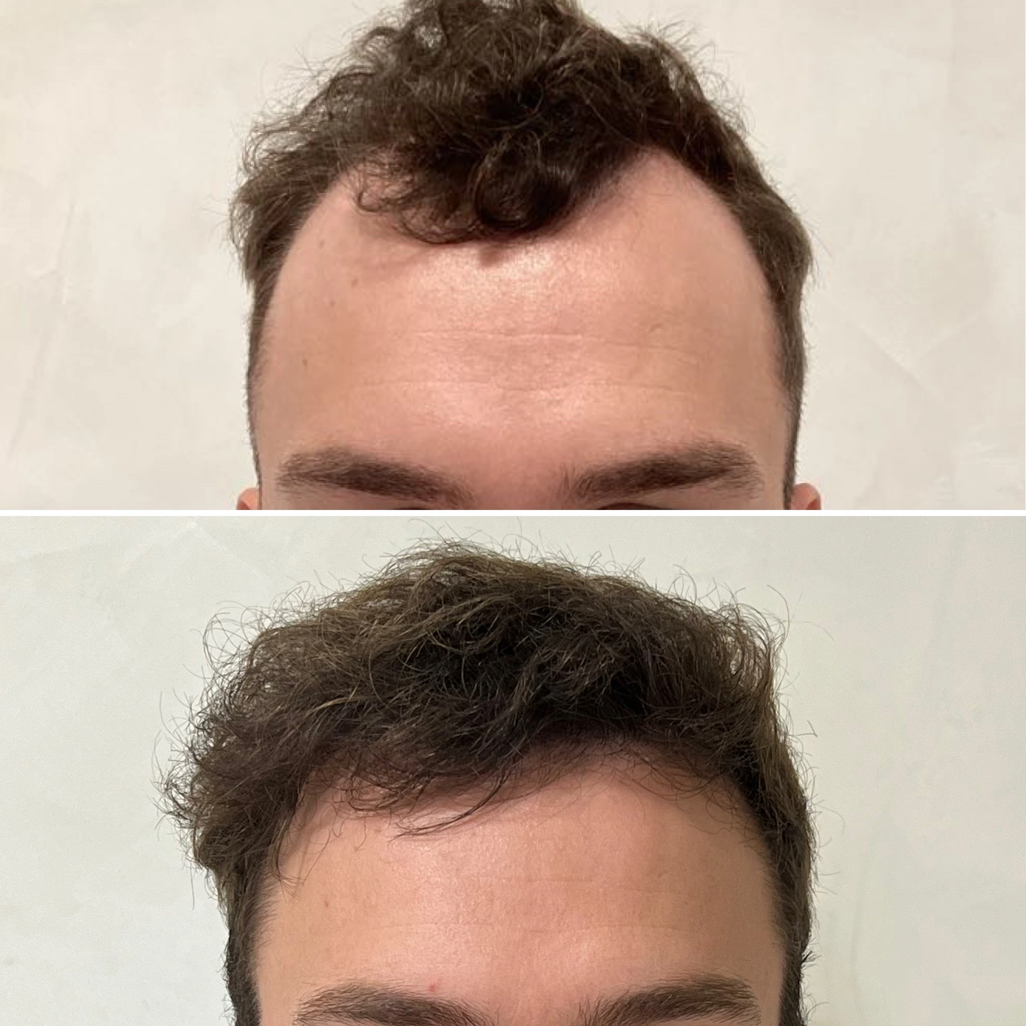 avant après greffe capillaire ligne frontale et golfes avant après greffe capillaire ligne frontale et golfes résultat naturel bordeaux