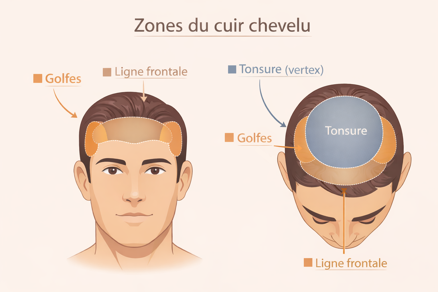 Schéma des zones du cuir chevelu en greffe capillaire : golfes, ligne frontale et tonsure (vertex)