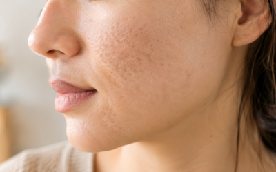 Cicatrices d’acné à Bordeaux : microneedling et peelings, résultats et fréquence