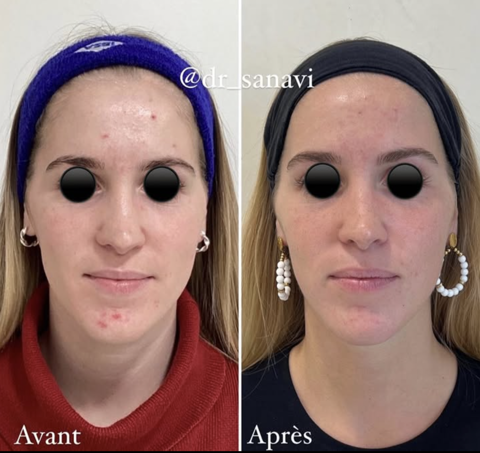  résultats microneedling cicatrices acné peau plus régulière<br />
