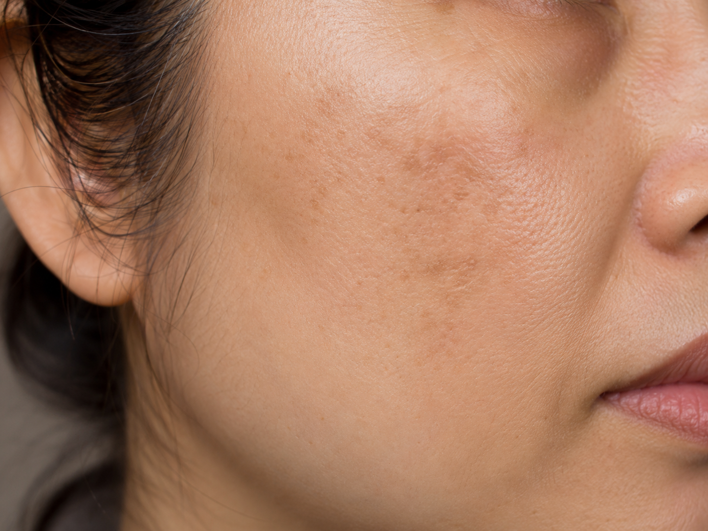  taches brunes visage taches solaires peau Bordeaux