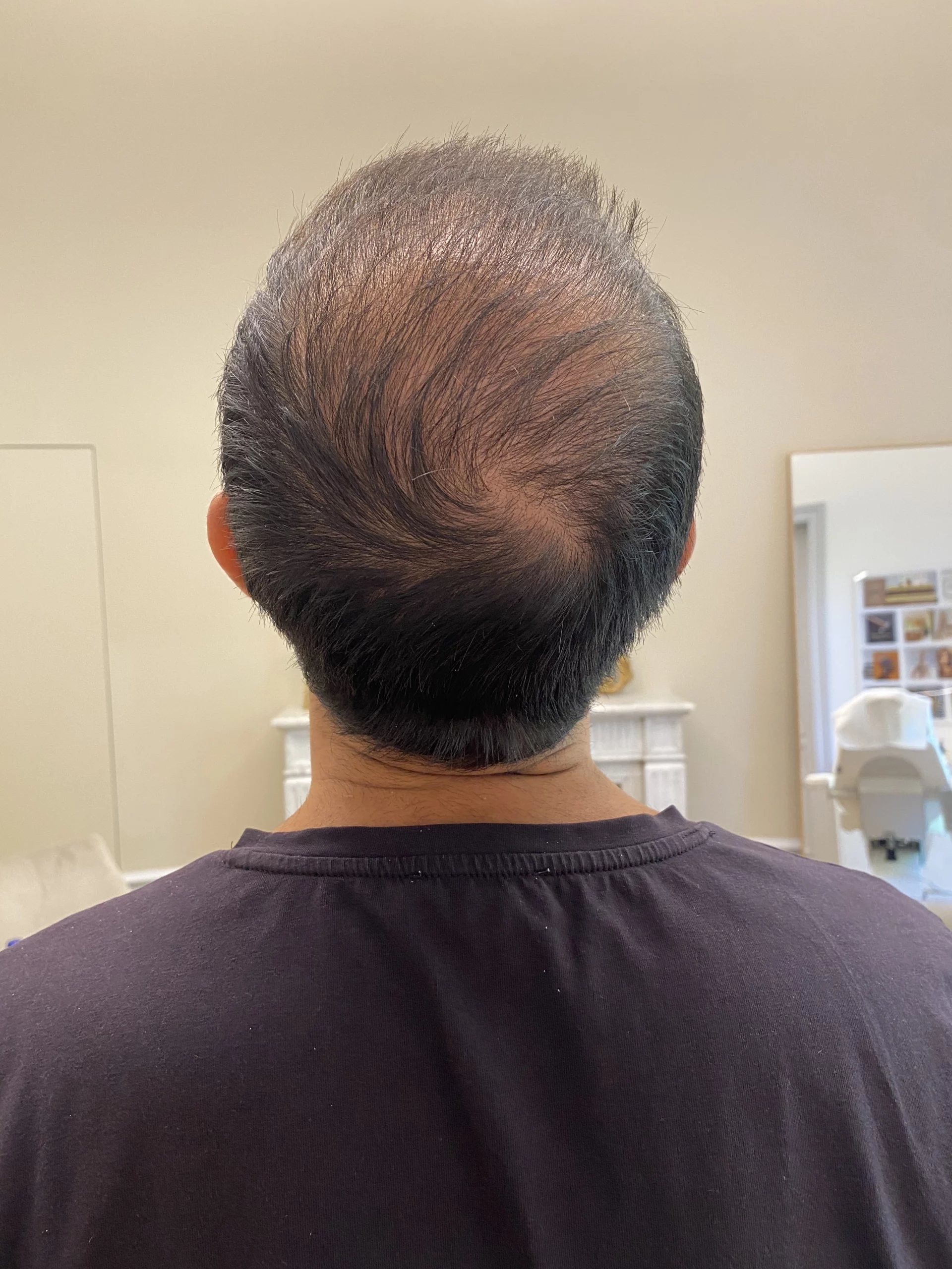 évolution calvitie après greffe capillaire cheveux natifs clairsemés