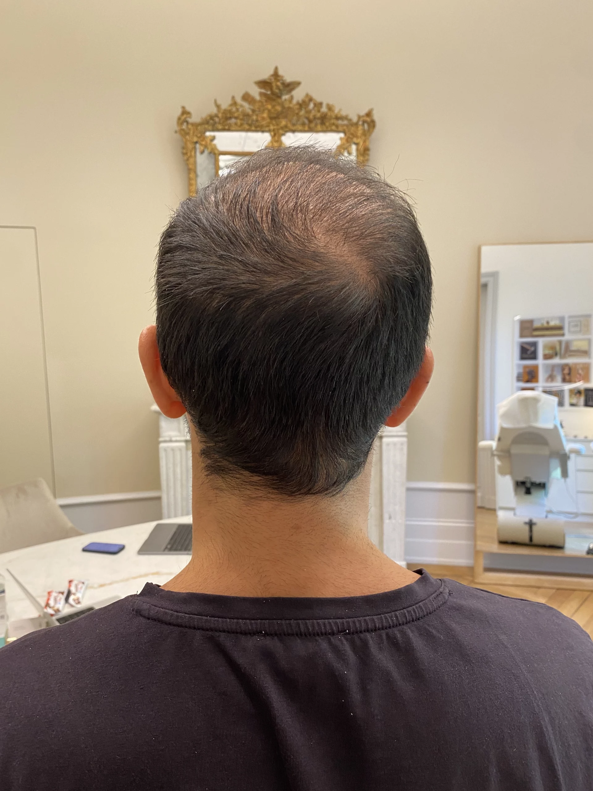 greffe capillaire résultat durable évolution calvitie cheveux natifs