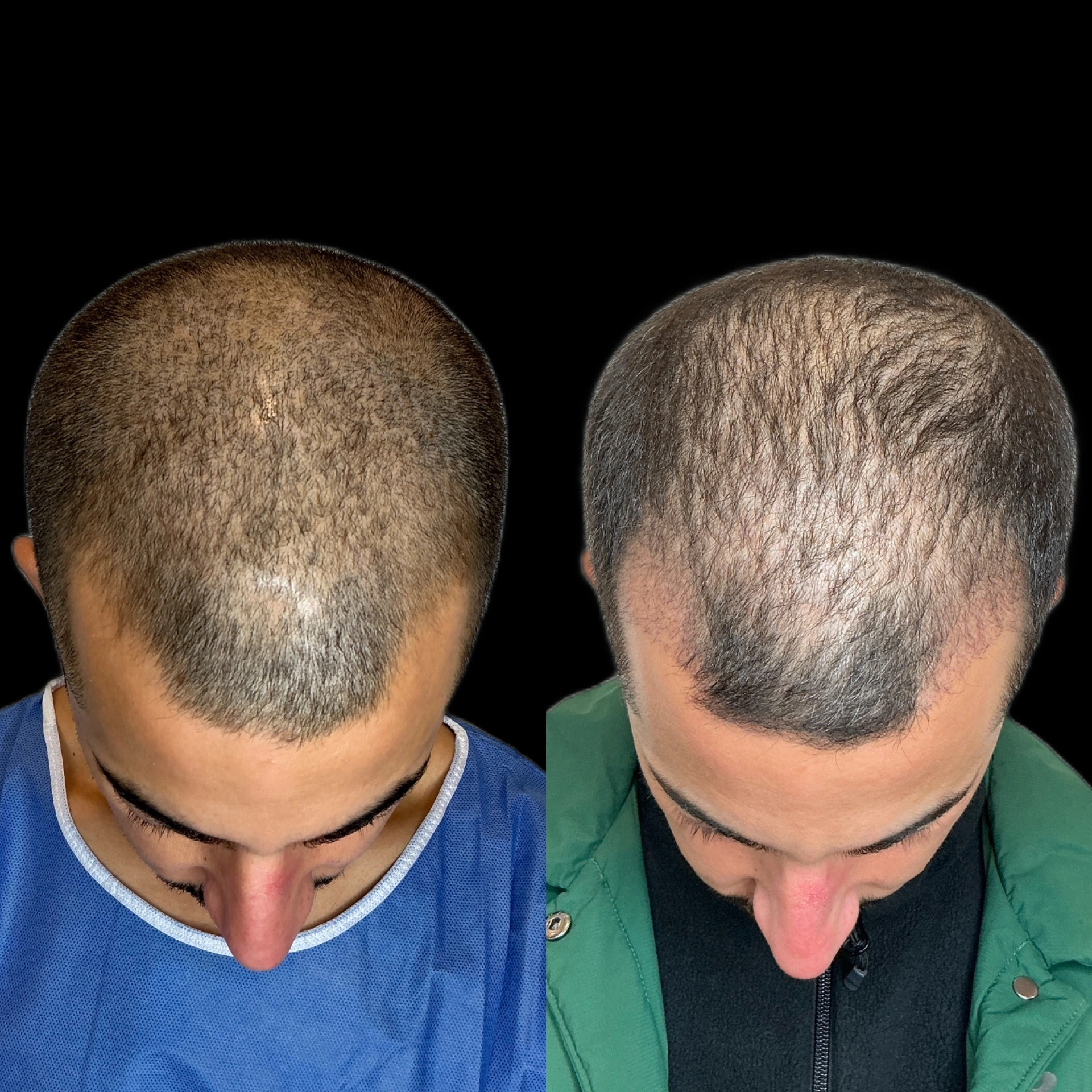 shock loss shedding après greffe capillaire perte temporaire cheveux